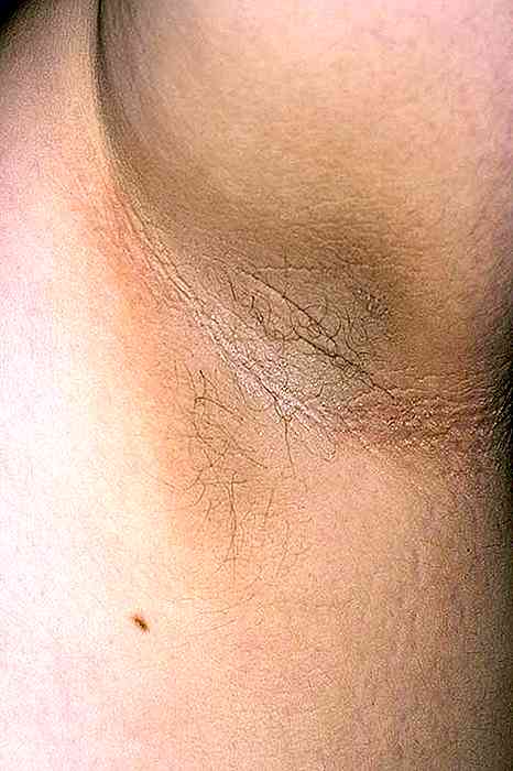 Acanthosis Nigricans Sintomi, cause, trattamenti e prognosi