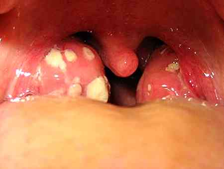 Vorbeugen tonsillensteine Tonsillensteine