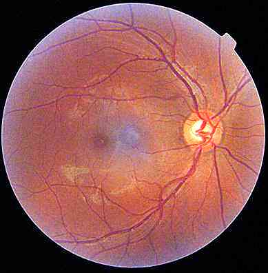 Optica neurită simptome, cauze și tratamente
