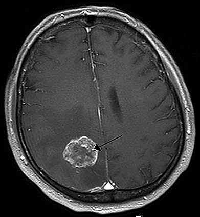 Tipi di tumori al cervello, sintomi e cause